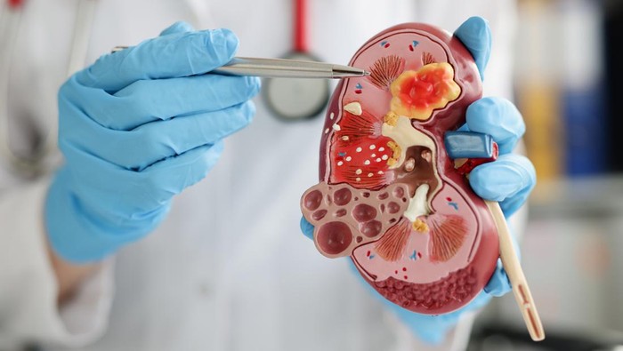Ilustrasi ginjal. Getty Images/iStockphoto/Ivan-balvan). Selasa (3/9/2025).